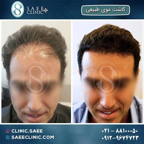 FIT hair transplantation - Saee Skin and Hair Clinic
