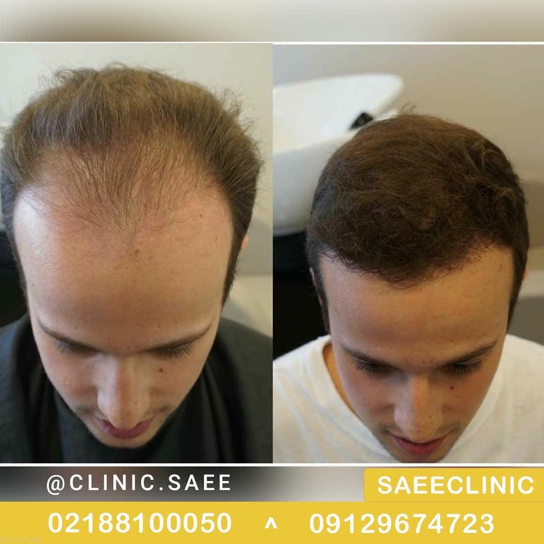 Hair transplantation and subsequent actions - Saee Skin and Hair Clinic