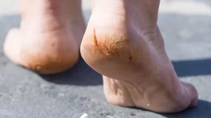 ترک پاشنه پا چگونه ایجاد می شود؟ / راه های جلوگیری و درمان