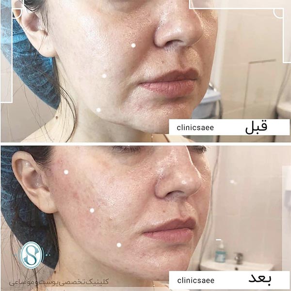 عکس تاثیر دستگاه آتیوا
