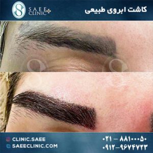 نمونه کاشت ابرو
