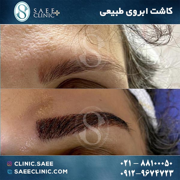 هزینه کاشت ابرو کلینیک ساعی