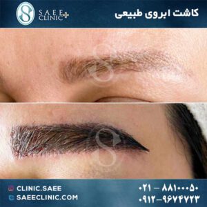 عکس کاشت ابرو
