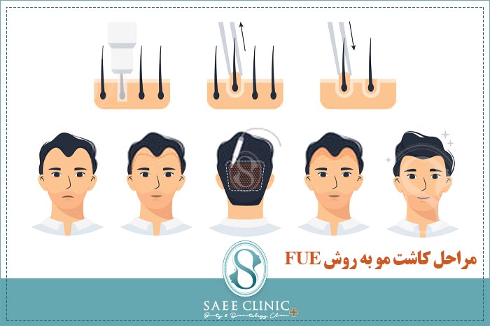 مراحل کاشت مو به روش FUE