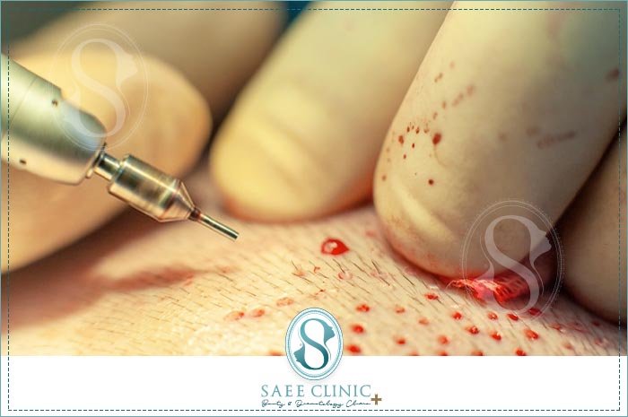 پانچ میلیمتری روش کاشت موی FUE