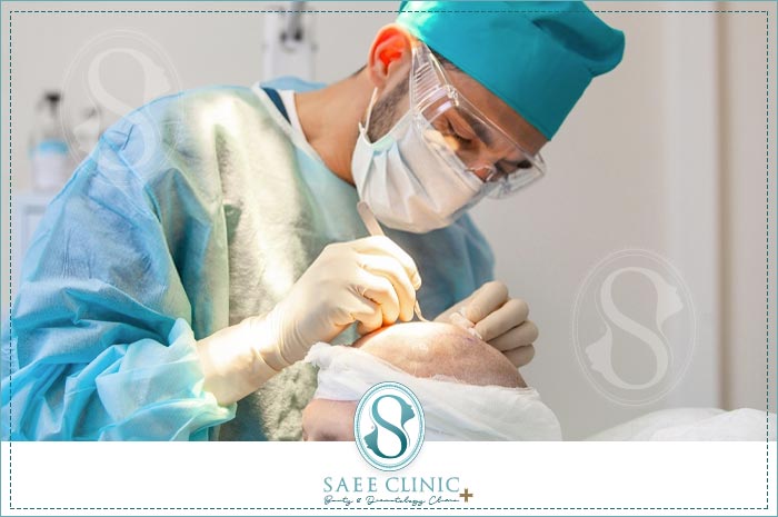کاشت مو در روش کاشت موی FUE