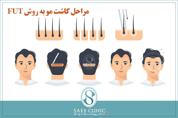 مراحل کاشت مو به روش FUT
