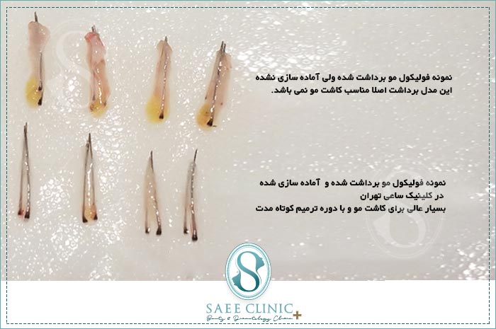 نمونه گرافت مو آماده شده در کلینیک ساعی