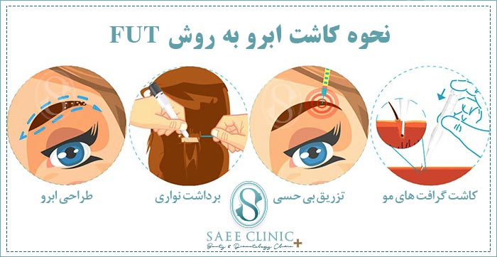 مراحل کاشت ابرو به روش FUT