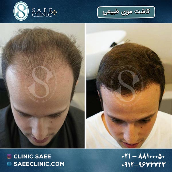عکس قبل و بعد از کاشت مو