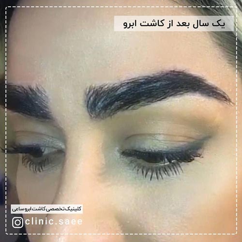 یکسال بعد از کاشت ابرو