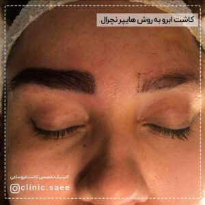 عکس کاشت ابرو کلینیک ساعی