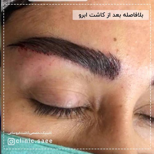 عکس کاشت ابرو