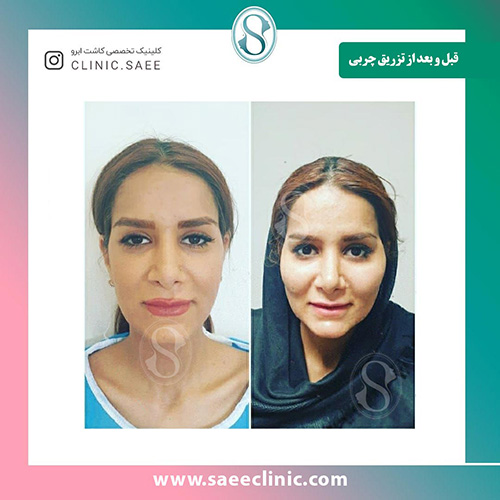 نمونه قبل و بعد از تزریق چربی به صورت