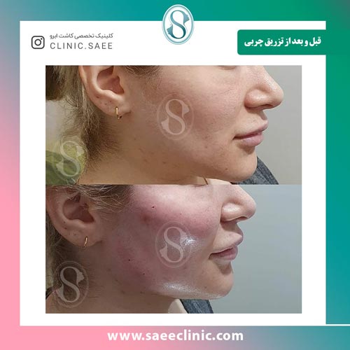 نمونه قبل و بعد از تزریق چربی به صورت