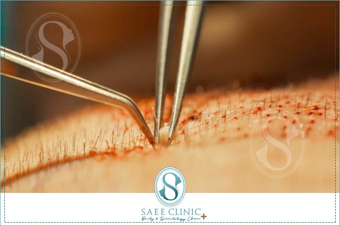 برداشت مو در روش Micro FIT