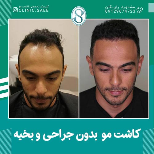 عکس کاشت مو در کلینیک ساعی