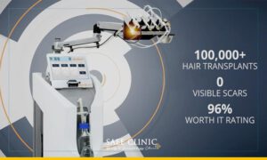 کاشت مو به روش NeoGraft