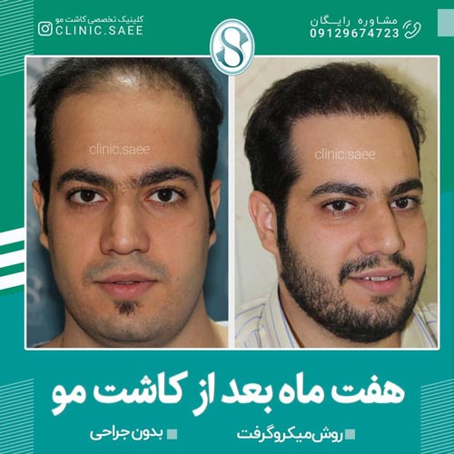 نمونه کاشت مو به روش میکروگرافت