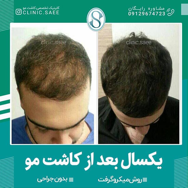کاشت مو به روش میکروگرافت در کلینیک ساعی تهران