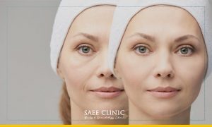 تزریق چربی یا تزریق ژل