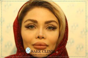 تزریق ژل