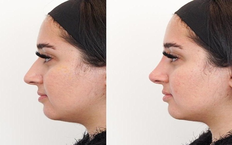 مزایای تزریق ژل به بینی نسبت به جراحی