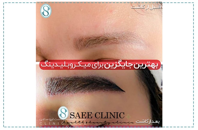 کاشت ابرو دخترانه