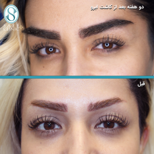 نمونه کار کاشت ابرو