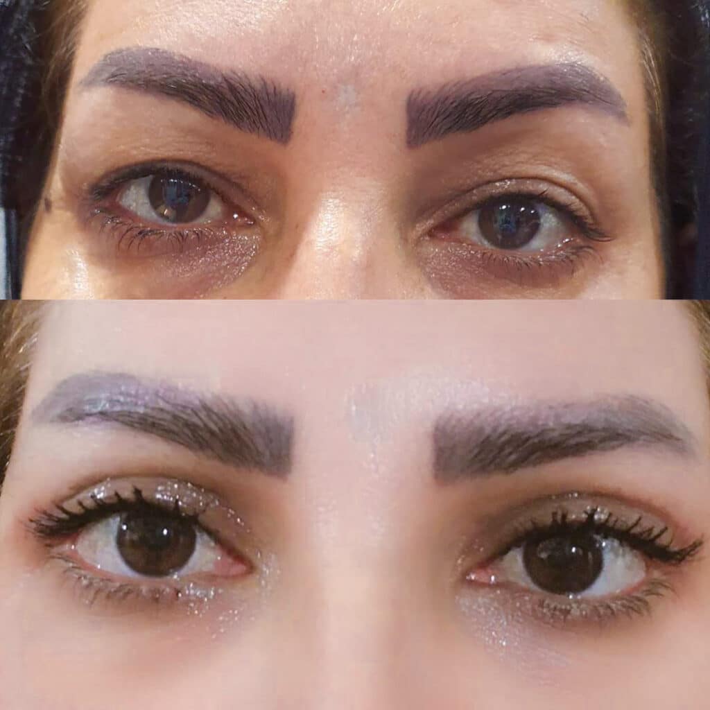 نمونه کار بلفاروپلاستی