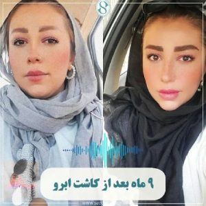 عکس قبل و بعد کاشت ابرو