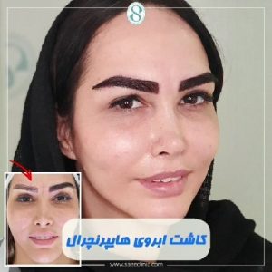 نمونه عکس قبل و بعد کاشت ابرو
