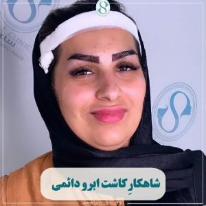 عکس از شاهکار کاشت ابروی دائمی در کلینیک ساعی تهران