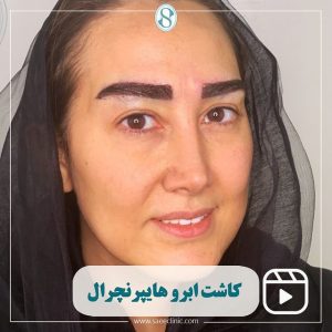کاشت ابرو هایپر نچرال
