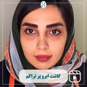 عکس کاشت ابرو پر تراکم