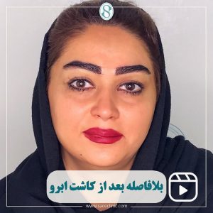 عکس کاشت ابرو فوری بعد از عمل