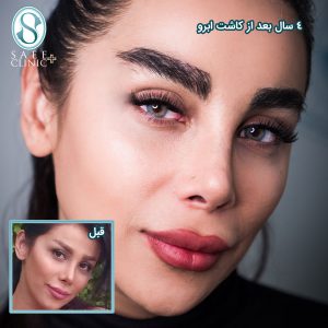 هزینه کاشت ابرو